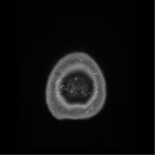 Anaplastic astrocytoma IDH wild-type (pseudoprogression) (Radiopaedia 42209-45276 Axial T1 C+ 146).png