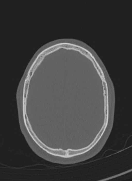Anaplastic oligodendroglioma with skull fracture (Radiopaedia 74831-85846 Axial bone window 6).png
