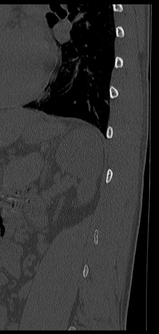 Aneurysmal bone cyst T11 (Radiopaedia 29294-29721 Sagittal bone window 11).jpg