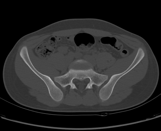 File:Aneurysmal bone cyst of ischium (Radiopaedia 25957-26094 Axial bone window 20).png