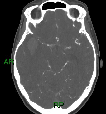 File:Aneurysmal subarachnoid hemorrhage with intra-axial extension (Radiopaedia 84371-99732 A 29).jpg