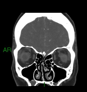 File:Aneurysmal subarachnoid hemorrhage with intra-axial extension (Radiopaedia 84371-99732 C 81).jpg