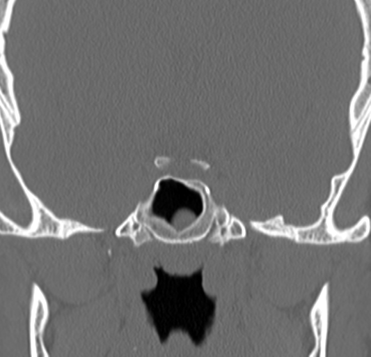 Angular epidermoid cyst (Radiopaedia 46908-51439 Coronal bone window 50).png
