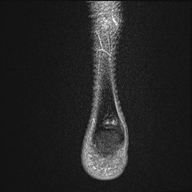 File:Ankle syndesmotic injury (Radiopaedia 69066-78837 Coronal PD fat sat 4).jpg
