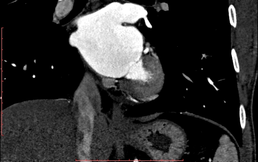 Anomalous left coronary artery from the pulmonary artery (ALCAPA) (Radiopaedia 70148-80181 B 206).jpg