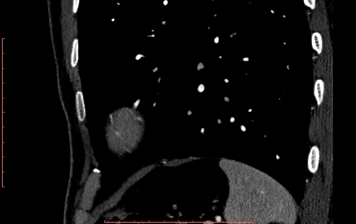 Anomalous left coronary artery from the pulmonary artery (ALCAPA) (Radiopaedia 70148-80181 C 262).jpg