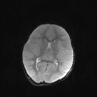 File:Anoxic brain injury (Radiopaedia 79165-92139 Axial DWI 13).jpg
