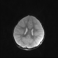 File:Anoxic brain injury (Radiopaedia 79165-92139 Axial DWI 16).jpg