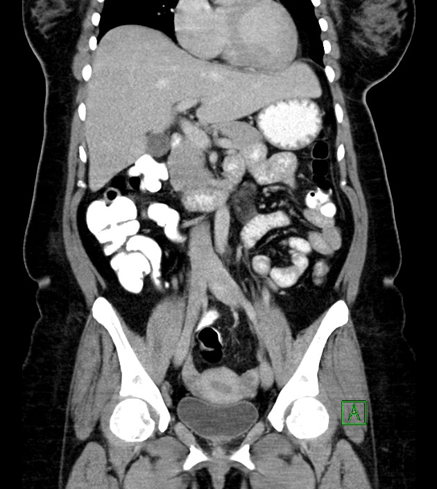 Anterior abdominal wall CSF pseudocyst (CSFoma) (Radiopaedia 79453-92571 B 27).jpg