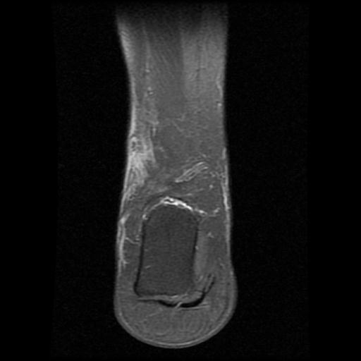 File:Anterior calcaneal process fracture (Radiopaedia 71377-81705 Coronal PD fat sat 14).jpg