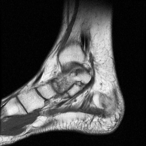 File:Anterior calcaneal process fracture (Radiopaedia 71377-81705 Sagittal T1 13).jpg