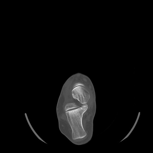 Anterior calcaneal process fracture (Radiopaedia 82590-96762 Axial bone window 19).jpg