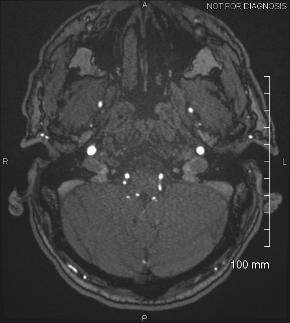 Anterior cerebral artery aneurysm (Radiopaedia 80683-94127 Axial MRA 28).jpg