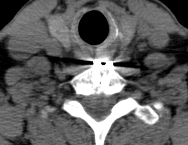 Anterior cervical postdiscectomy arthrodesis (Radiopaedia 32678-33646 Axial non-contrast 60).jpg