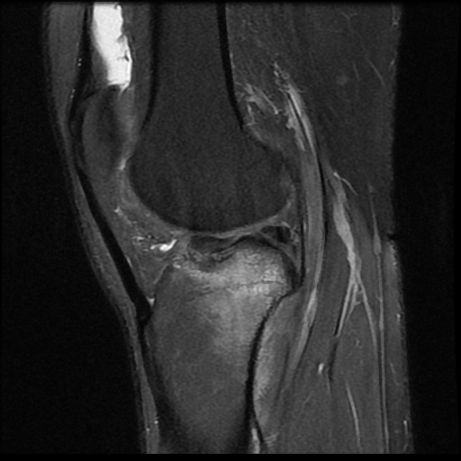 File:Anterior cruciate ligament avulsion fracture (Radiopaedia 58939-66193 Sagittal PD fat sat 9).jpg