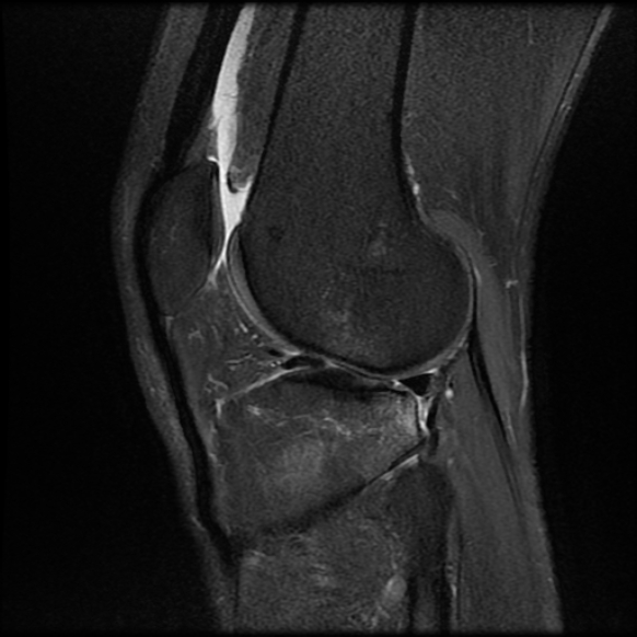 File:Anterior cruciate ligament graft tear and bucket-handle tear of medial meniscus (Radiopaedia 75867-87254 Sagittal PD fat sat 20).jpg