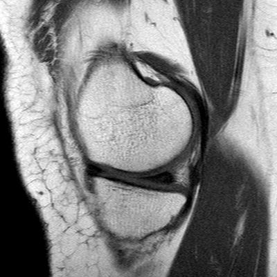 Anterior cruciate ligament mucoid degeneration (Radiopaedia 60853-68633 Sagittal T1 9).jpg