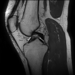 Anterior cruciate ligament rupture and posteromedial corner injury (Radiopaedia 67338-76723 Sagittal PD 79).jpg