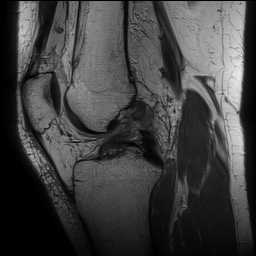 Anterior cruciate ligament rupture with Segond fracture (Radiopaedia 69043-78806 Sagittal PD 95).jpg