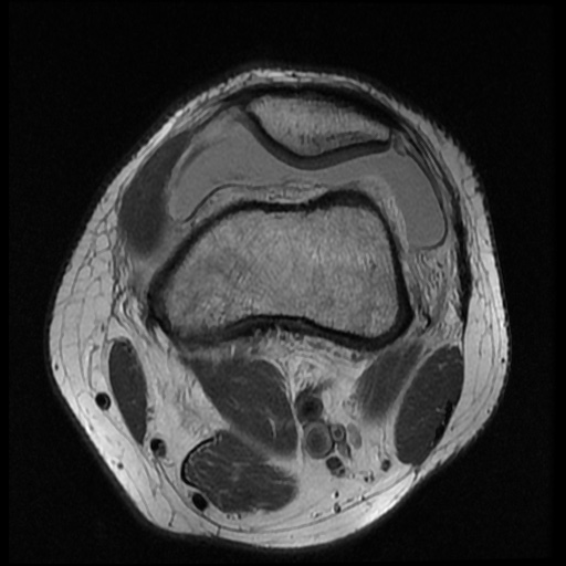 File:Anterior cruciate ligament tear (Radiopaedia 61500-69462 Axial PD 4).jpg