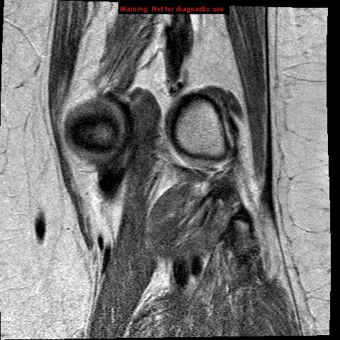 File:Anterior cruciate ligament tear - complete (Radiopaedia 12175-12514 C 20).jpg