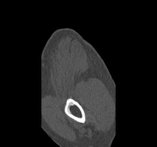 Anterior glenohumeral dislocation with Hill-Sachs lesion (Radiopaedia 62877-71249 Sagittal bone window 6).jpg