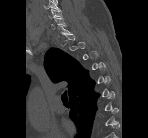 Anterior glenohumeral dislocation with Hill-Sachs lesion (Radiopaedia 62877-71249 Sagittal bone window 76).jpg