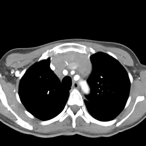 Anterior mediastinal lymphoma (Radiopaedia 29556-30061 C 14).jpg
