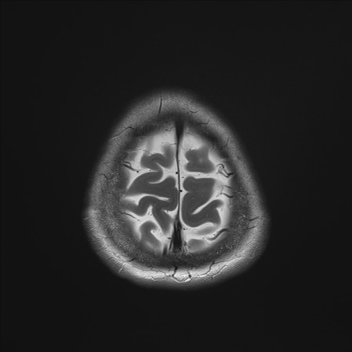 File:Anterior temporal encephalocele (Radiopaedia 82624-96808 Axial T2 36).jpg