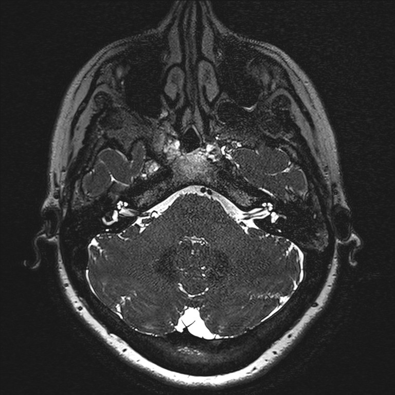 Anterior temporal encephalocele (Radiopaedia 82624-96808 Axial T2 high res 11).jpg