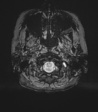 Anterior temporal pole cysts (Radiopaedia 46629-51102 Axial SWI 5).png