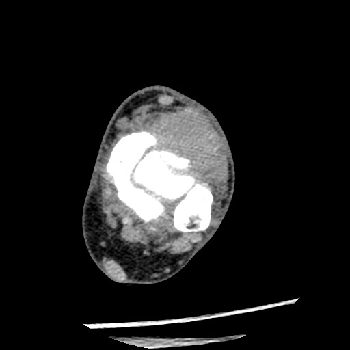 Anterior tibial artery false aneurysm (Radiopaedia 88984-105809 A 116).jpg