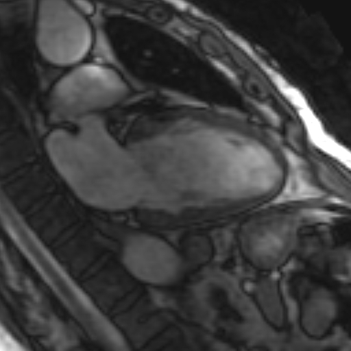 File:Anteroseptal hypokinesia after myocardial infarction (Radiopaedia 15978-15633 2 chamber view SSFE 20).jpg