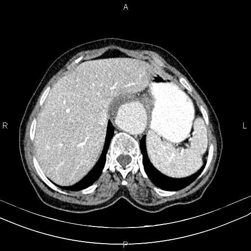 File:Aortic aneurysm and Lemmel syndrome (Radiopaedia 86499-102554 A 17).jpg