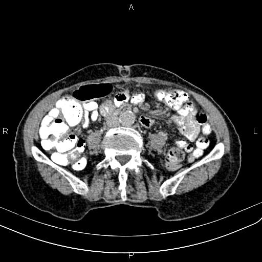 Aortic aneurysm and Lemmel syndrome (Radiopaedia 86499-102554 Axial C+ delayed 47).jpg