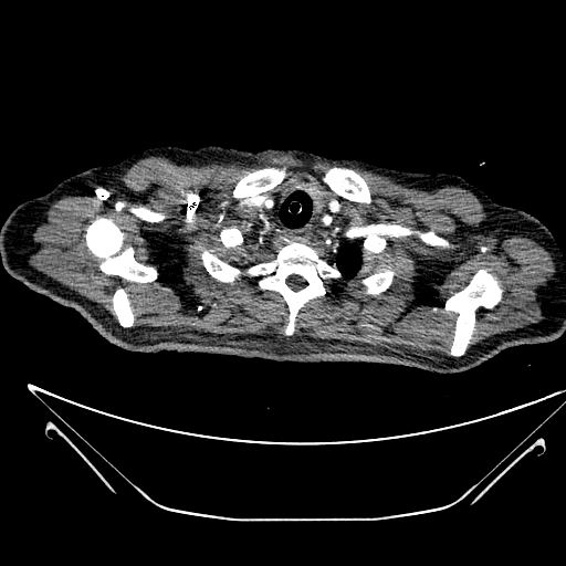 File:Aortic arch aneurysm (Radiopaedia 84109-99365 B 65).jpg