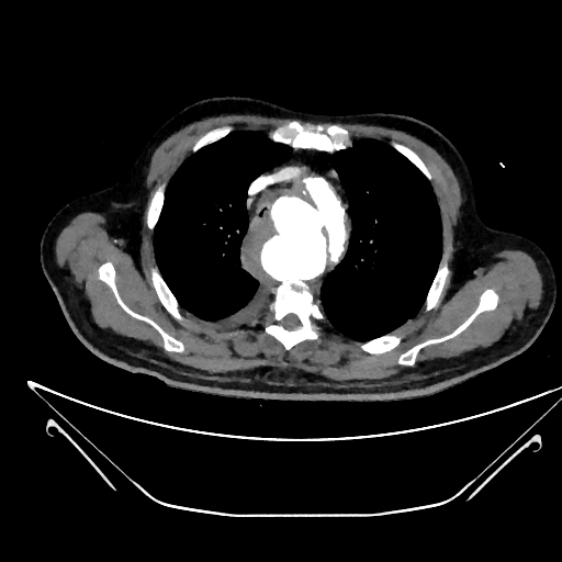 Aortic arch aneurysm (Radiopaedia 84109-99365 C 93).jpg