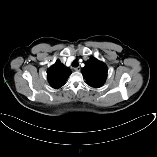 Aortic arch origin of left vertebral artery (Radiopaedia 46327-50737 Axial post contrast 19).jpg