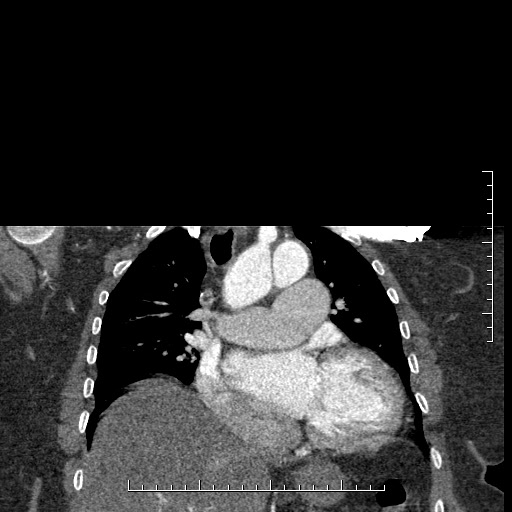 File:Aortic dissection- Stanford A (Radiopaedia 35729-37268 E 34).jpg