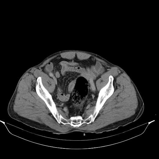 Aortic dissection- Stanford type A (Radiopaedia 22085-22085 Axial C+ delayed 45).jpg