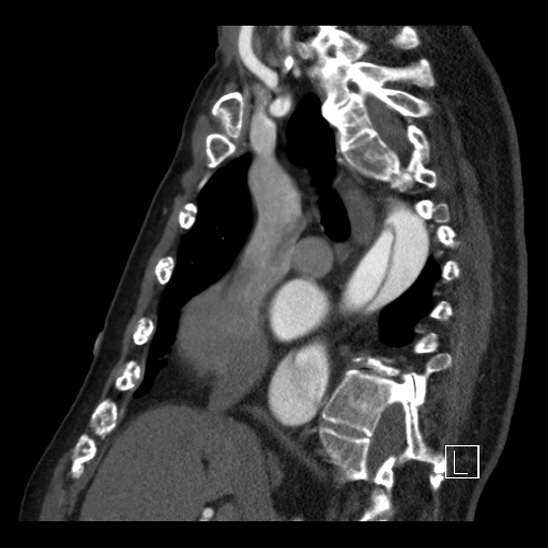 File:Aortic dissection (CTPA) (Radiopaedia 75506-86750 C 48).jpg