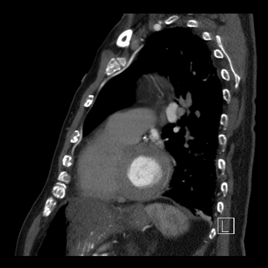 File:Aortic dissection (CTPA) (Radiopaedia 75506-86750 C 71).jpg