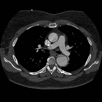 File:Aortic dissection (Radiopaedia 57969-64959 A 135).jpg