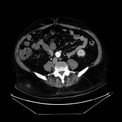 Aortic dissection (Radiopaedia 62562-71000 A 80).jpg