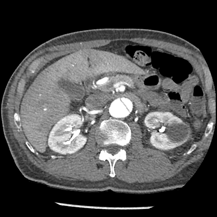 Aortic dissection - DeBakey Type I-Stanford A (Radiopaedia 79863-93115 A 46).jpg