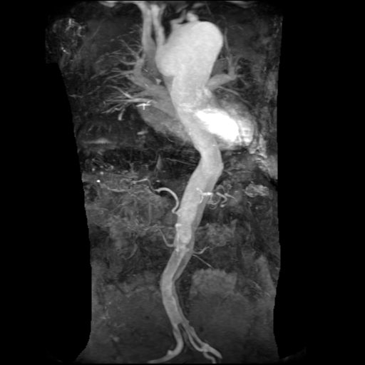 File:Aortic dissection - Stanford A - DeBakey I (Radiopaedia 23469-23551 MRA 1).jpg