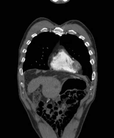 Aortic dissection - Stanford type B (Radiopaedia 73648-84437 B 23).jpg