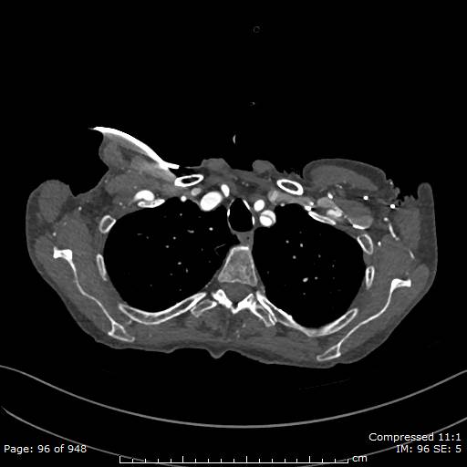 File:Aortic dissection with extension into aortic arch branches (Radiopaedia 64402-73204 B 96).jpg