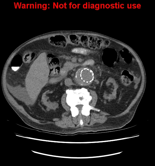 File:Aortic graft infection (Radiopaedia 44979-48907 Axial non-contrast 47).jpg