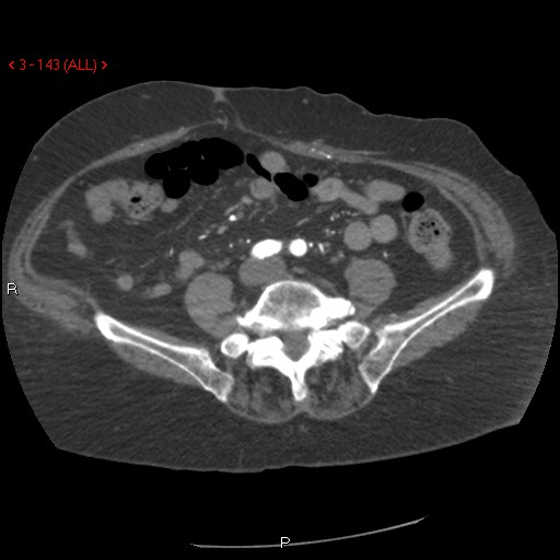Aortic intramural hematoma (Radiopaedia 27746-28001 A 143).jpg